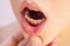 Mouth Ulcers: मुंह के छाले कर रहे हो परेशान तो करें ये घरेलू उपाय