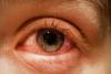 Conjunctivitis Eye Flu: बच्चों में फैल रहे आई फ्लू ने अभिभावकों की बढ़ाई टेंशन, चश्मा लगाकर स्कूल जा रहे छात्र-छात्राएं