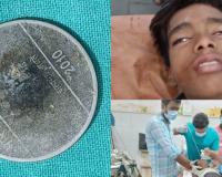 हरदोई के डॉक्टर का कमाल: 7 साल से बच्चे के गले में फँसा था सिक्का, सर्जरी कर निकाला