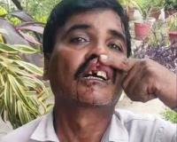 हल्द्वानी: लग्जरी कार के चालक ने तोड़ा रोडवेज बस ड्राइवर का दांत