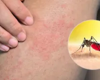 Dengue in prayagraj : 17 दिन में मिले 78 मरीज,  बेली अस्पताल में 25 और डेंगू वार्ड में 24 मरीज भर्ती 