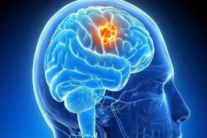 मूत्र की जांच से भी पता लगाया जा सकता है Brain Tumor, अध्ययन में हुआ खुलासा