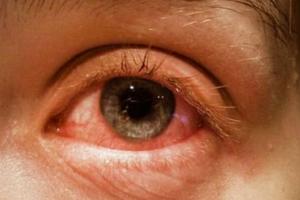 Conjunctivitis Eye Flu: बच्चों में फैल रहे आई फ्लू ने अभिभावकों की बढ़ाई टेंशन, चश्मा लगाकर स्कूल जा रहे छात्र-छात्राएं